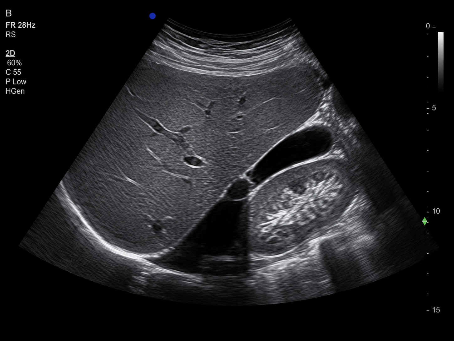 Normal abdominal liver ultrasound example